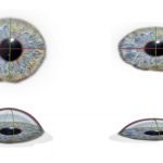 C’est quoi l’astigmatisme, être astigmate