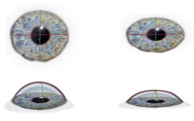 C’est quoi l’astigmatisme, être astigmate
